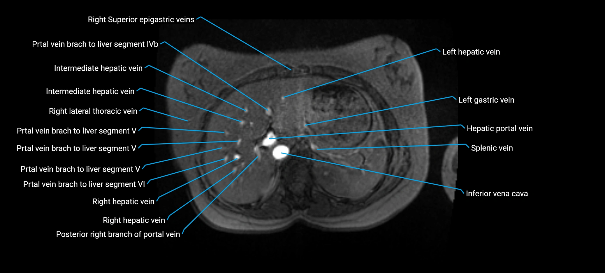 MRV abdomen pelvis & lower limb axial cross sectional anatomy labelled MRI image 41 (1).webp